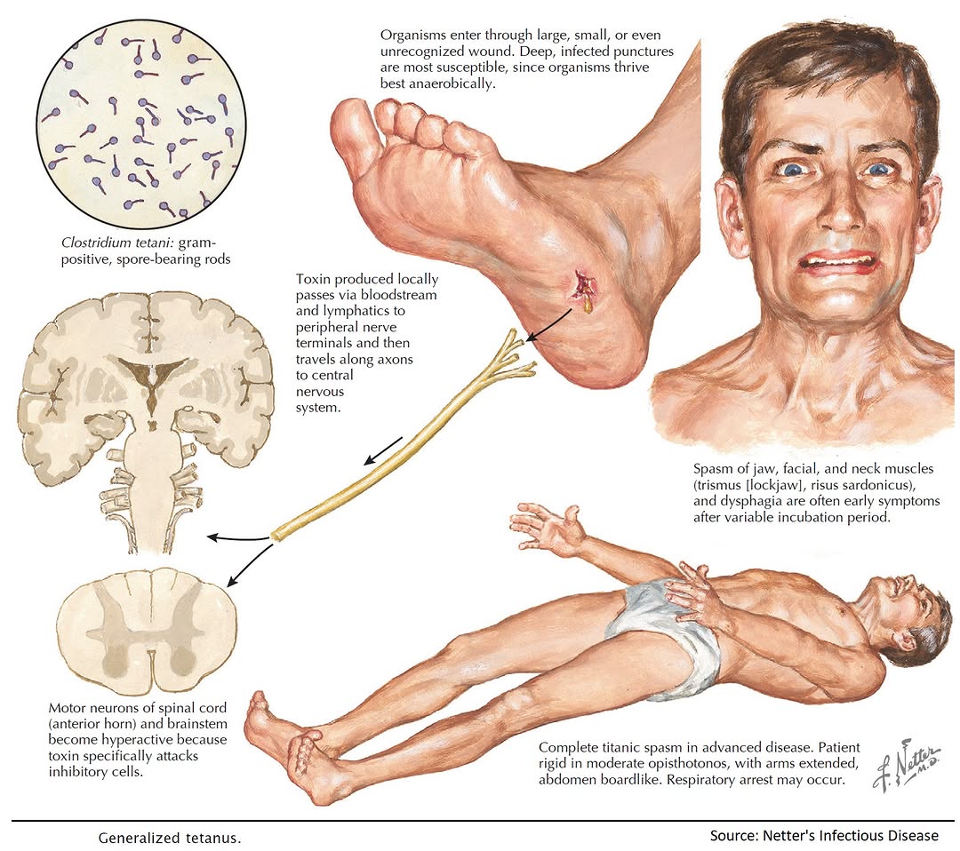 tetanus vaccine algorithm